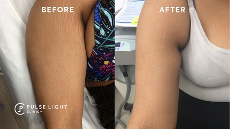 Stretch Mark Removal | Pulse Light Clinic London Laser Stretch Mark Removal, Strech Marks, Marks Cream, Fractional Laser, Scar Cream, Stretch Mark Removal, Stretch Mark Cream, Stretch Mark, Skin Essentials