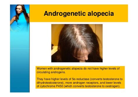 Androgenetic alopecia in Women ...scary because this type of hair probably will never grow back Androgenic Alopecia, Thick Hair Remedies, Thick Hair Growth, Androgenetic Alopecia, Male Pattern Baldness, Hair Remedies For Growth, Pattern Baldness, Female Hair, Grow Long Hair