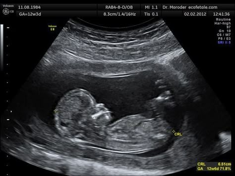 Baby Ultrasound Pictures, Pregnancy Ultrasound, Baby Ultrasound, Ultrasound Tech, Ultrasound Pictures, Mang Thai, Unborn Baby, Baby Boy Photos, Baby Memories