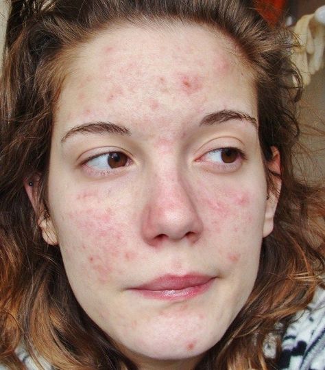 Strawberry Freckles, Acne Positive, Girl With Acne, Acne Positivity, Skin Positivity, Normal Face, Acne Beauty, Real Skin, Natural Acne Remedies