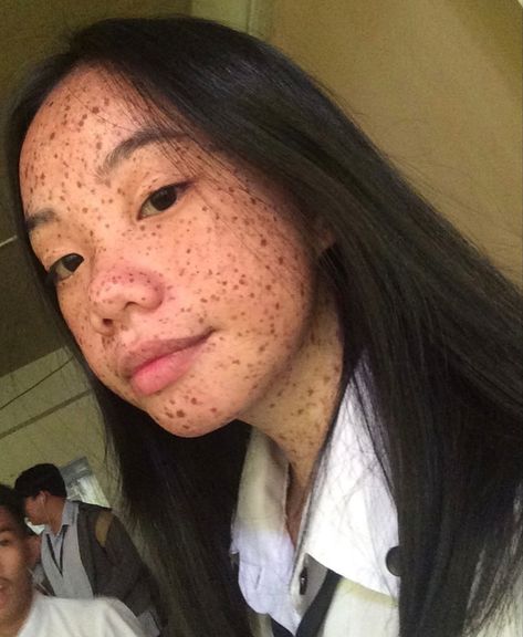 Asian Freckles, Girl With Acne, Treatments For Acne, Skin Positivity, Faces Of People, The Moment You Realize, No Wrinkles, Freckle Face, Treat Acne