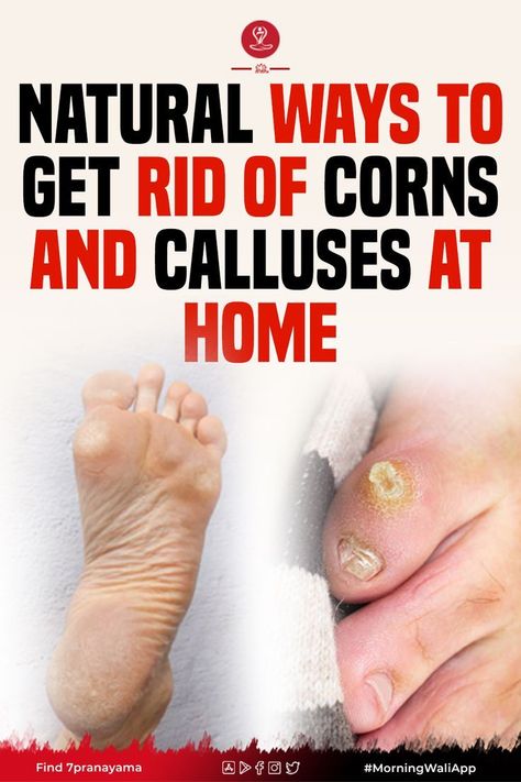 dry cracked feet home remedy remedies Dry Skin Home Remedies, Vitamins For Clear Skin, Get Rid Of Corns, Nails Remedies, Remedies For Cracked Heels, Heal Cracked Heels, Cracked Heel Remedies, Nail Fungus Remedies, Cleaning With Hydrogen Peroxide