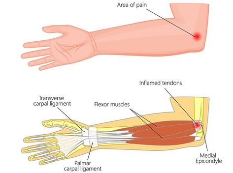 Medial Epicondylitis (Golfer’s Elbow) Medial Epicondyle, Golfers Elbow, Forearm Muscles, Moist Heat, Orthopedic Surgery, Tennis Elbow, Physician Assistant, Occupational Therapist, Stretching Exercises