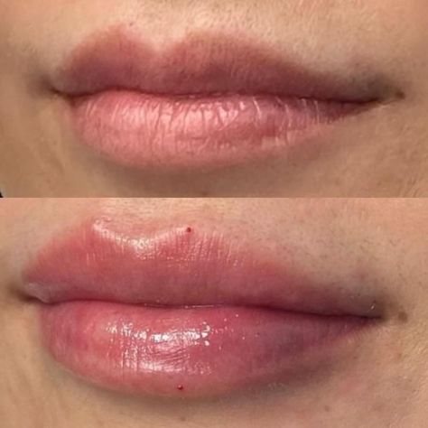 It’s November and the holidays are upon us, just like that! This is your sign to book an appointment for lip filler and look extra gorgeous all season long!💋#lipfiller #lips #nurseinjector #filler #juvaderm #juvadermlips #restalynekysse #beauty #minneapolis #edenprairie #topinjector #aesthetics Lip Filler For Small Lips, Babydoll Lip Filler, Best Lip Fillers Before And After, Slight Lip Filler, Flat Lips Filler, Small Mouth Lip Fillers, Natural Lip Filler Inspiration, Lip Filler Half Syringe, Minimal Lip Fillers