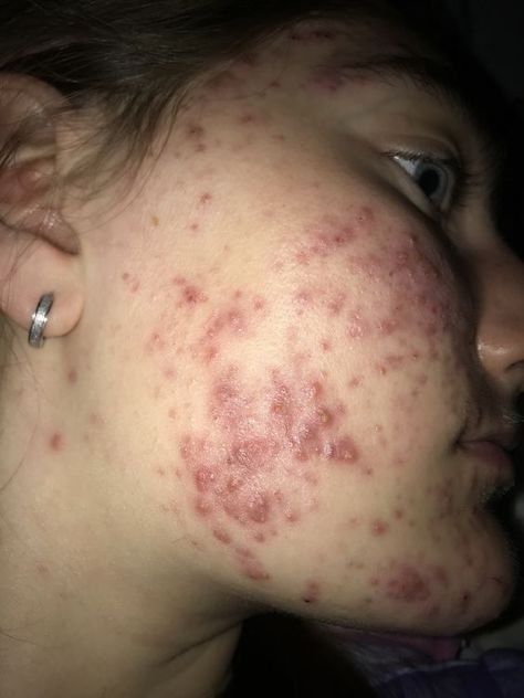 Acne Positive, Acne Photos, Pimple Face, Acne Positivity, Skin Positivity, Pimple Solution, Massage Images, Bad Acne, Get Rid Of Pimples