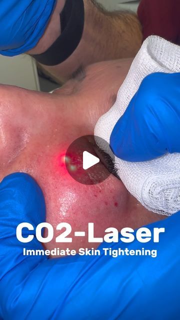 Raphael Weiland on Instagram: "Watch the immediate skin tightening 🤯 #sthetic #co2laser #hautstraffung #skintightening" Skin Tightening, Skin, Instagram