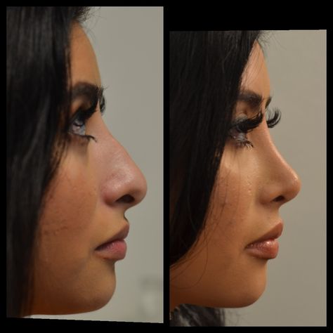 Droopy Tip Nose Rhinoplasty, Round Face Nose Job, Nose Job Front Profile, Nose Job Inspiration Front View, Nose Job Inspo Front View, Nosejob Rhinoplasty Before After, Nose Job Inspiration Natural, Nose Job Front View, Bulbous Nose Rhinoplasty Before After