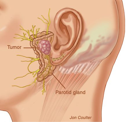 salivary-gland-tumours Parotid Gland Swelling, Salivary Gland Infection, Ent Clinic, Salivary Glands, Paranasal Sinuses, Nasal Obstruction, Parotid Gland, Ear Seeds, Facial Nerve