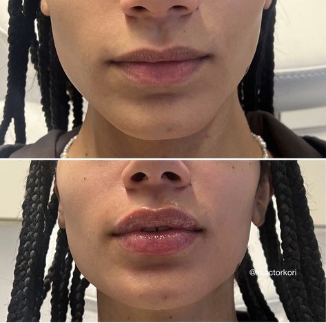 Narrow Mouth Lip Filler, Lip Filler Shape Ideas Black Women, 1.5 Ml Lip Filler, Defined Cupids Bow Lip Filler, Lip Filler Before And After Black Women, Lip Filler Before And After 1ml, Natural Lip Fillers 1ml, Lip Filler Black Women, Upper Lip Filler