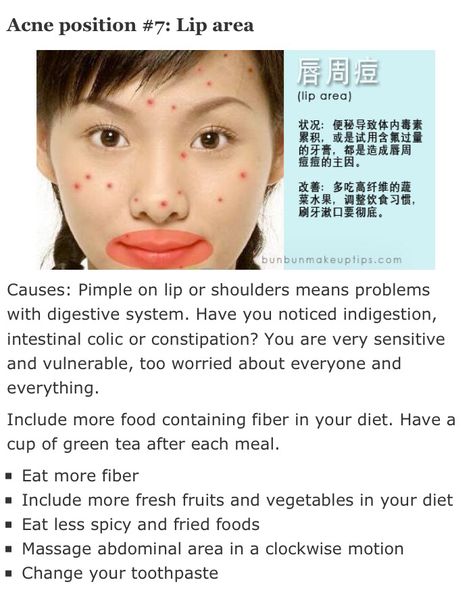 Pimple Chart, Pimples Around Lips, Pimples On Lip Line, Lip Pimple, Zit Remedy, Skin Mapping, Tips For Acne, Face Mapping Acne, Blind Pimple