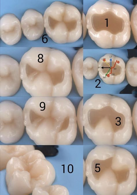 Esthetic Dentistry, Dental Hygiene Student, Dental Restoration, Dental Videos, Kedokteran Gigi, Dental Photography, Dental Hygiene School, Dentistry Student, Dental Anatomy