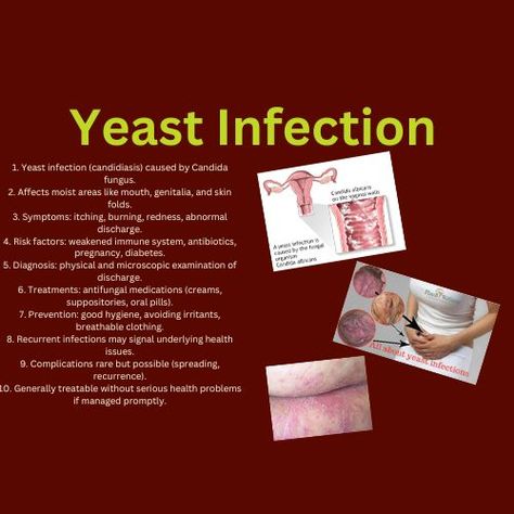 Yeast infection caused by Candida fungus affects moist areas presents symptoms such as itching and burning is diagnosed through physical and microscopic examination treated with antifungal medications preventable with good hygiene may indicate underlying health issues if recurrent and is generally manageable without serious complications if addressed promptly Yeast Infection Causes, Mary Robinson, Yeast Infection Symptoms, Candida Overgrowth, Health Issues, Health Problems, Yeast, Health Care, Health