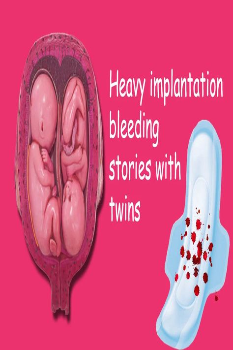 Heavy implantation bleeding twin stories Implantation Cramps, Twin Pregnancy, Single Mother, Single Mothers, The Good, Twins