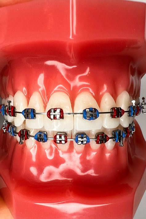 Are you ready to make a bold statement with your braces? Choosing red and blue braces bands is one way to do it! Discover 21 amazing red braces combinations that will turn heads and showcase your unique style. Say goodbye to boring and embrace a vibrant braces journey – you deserve it! Learn more inside the article. Braces Combos, Black Braces Bands, Dark Blue Braces, Light Blue Braces, Purple Braces, Braces Colors Combinations, Blue Braces, Green Braces, Red Braces