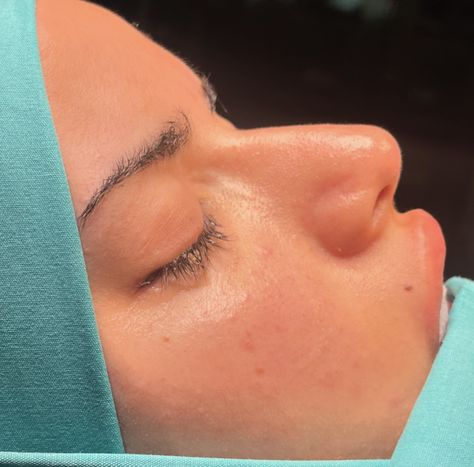 Good morning. Curved and little bit lifted nose style for my patient as she wishes 🤩 #rinoplasti #rhinoplasty #nosejob #nosesurgery #burunestetiği #estetikburun #rhinoplastyinistanbul #rhinoplastyexpert #rinoplasty Curved Nose, Nose Surgery, Nose Job, Good Morning, Quick Saves