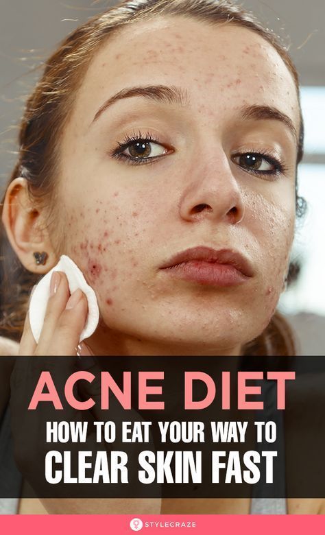 Anti Acne Diet, Acne Reasons, Clear Skin Diet, Clear Skin Fast, Acne Diet, Skin Diet, Natural Acne Remedies, How To Get Rid Of Pimples, Glow Skin