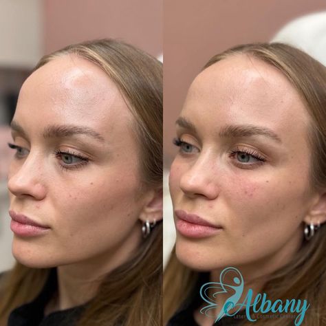 Aesthetic Procedures, Face Fillers, Hyaluronic Acid Fillers, Cheek Fillers, High Cheekbones, Smile Lines, Undereye Circles, Dermal Fillers, Lip Fillers