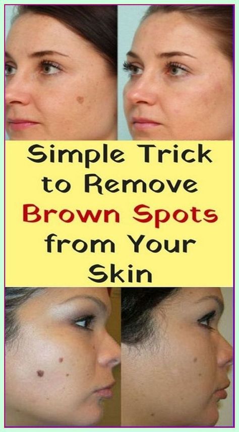 Simple Trick To Remove Brown Spots From Your Skin Black Spots On Face, Sunspots On Face, Brown Age Spots, Age Spot Removal, Brown Spots On Skin, Spots On Legs, Brown Spots Removal, Brown Spots On Face, Skin Spots