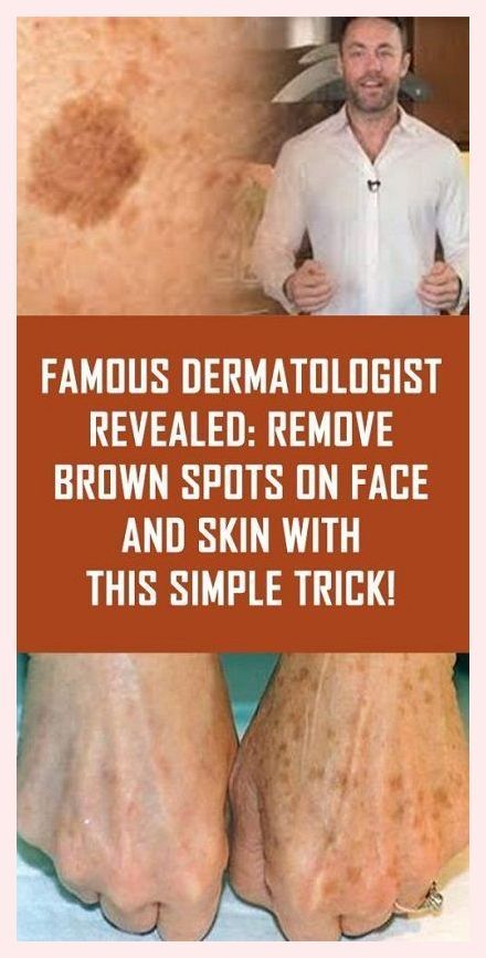 You have no idea how much this means to me. Splendorous valuable information! Black Spots On Face, Sunspots On Face, Brown Age Spots, Brown Spots On Skin, Natural Remedies For Allergies, Natural Headache Remedies, Brown Spots Removal, Brown Spots On Face, Skin Spots