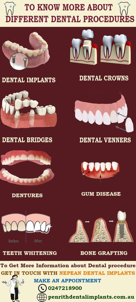 Dental Posters, Dental Videos, Dental Photography, Dentistry Student, Sedation Dentistry, Dental Facts, Implant Dentistry, Restorative Dentistry, Dental Bridge