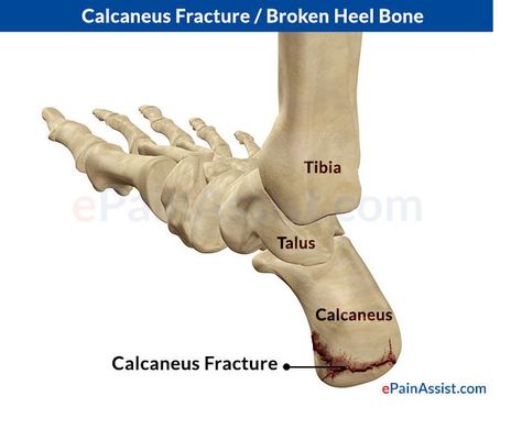 Foot Bones diagram - (3/4 Medial & Posterior view) - Calcaneus-Fracture - epainassist.com Bones Diagram, Calcaneus Fracture, Open Fracture, Skin Disorders, Broken Leg, Sports Injury, Calisthenics, Anatomy, Bones