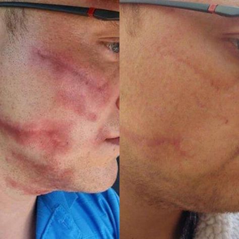 Before And After Acne, Dermapen Microneedling, Plasma Fibroblast, Skin Science, Brow Lash, Scarring, Scar Removal, Growth Factor, Conditioner