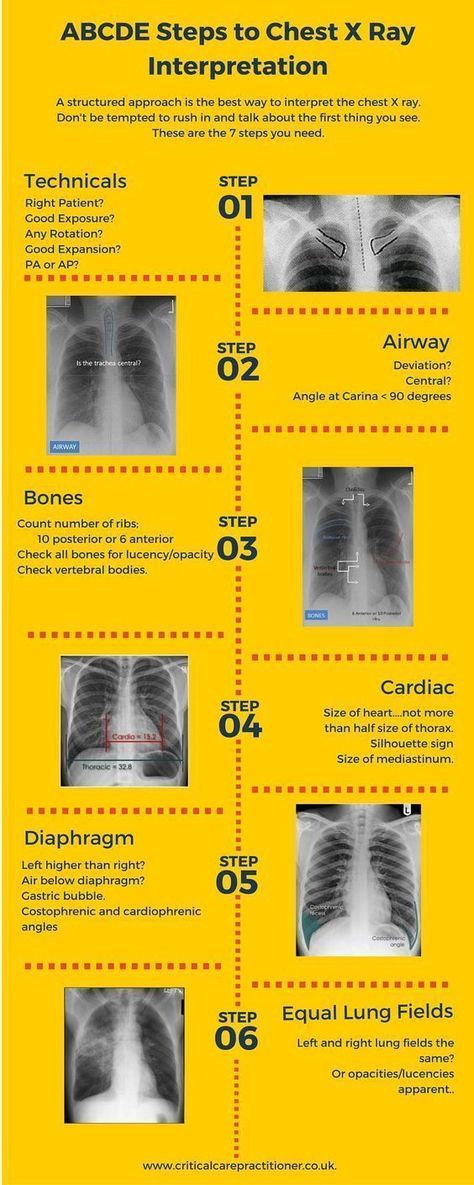 Chest X Ray, Radiology Student, Nursing Information, Radiology Imaging, Family Nurse Practitioner, Pulmonology, Respiratory Care, Respiratory Therapy, Nursing School Tips