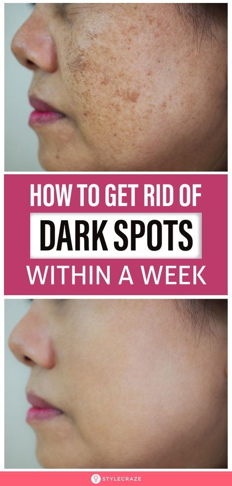 Dark Spot Remedies, Spots On Skin, Brown Spots On Skin, Wrinkle Remedies, Wrinkle Free Skin, Dark Spots On Face, Face Cleaning, Brown Spots Removal, Brown Spots On Face