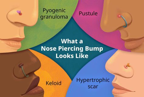 Nose Piercing Irritation Bump, Piercing Ideas Nose Stud, Nose Piercing Bump Remedies, How To Get Rid Of Piercing Bumps Fast, Bump On Nose Piercing, Nose Piercing Diy, Piercing Bump Remedy, Right Nose Piercing, Nose Ring Bump