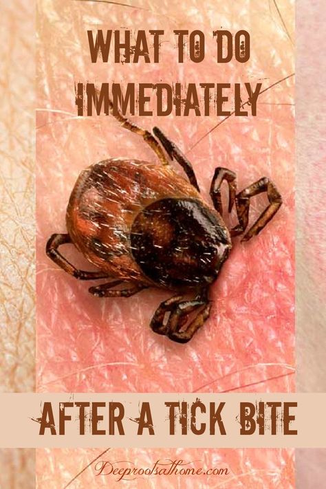 Deer Tick Bite, Homemade Medicine, Deer Ticks, Tick Removal, Tick Bite, Tick Repellent, Health Medicine, Medical Laboratory Science, Camping Nature