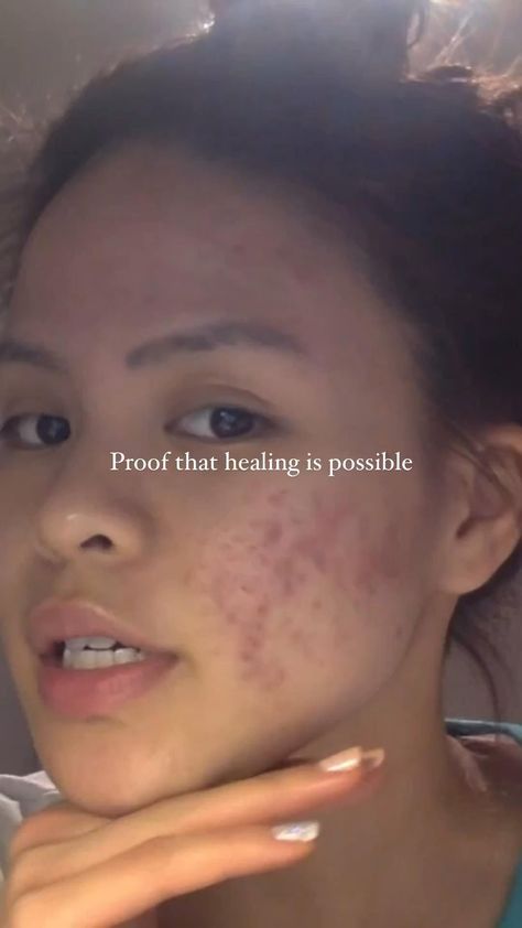 Acne journey Face Acne Remedies, Acne Journey, Cheek Acne, Best Acne Scar Removal, Face Mapping Acne, Acne Mask, Skin Hyperpigmentation, Serious Skin Care, Combo Skin