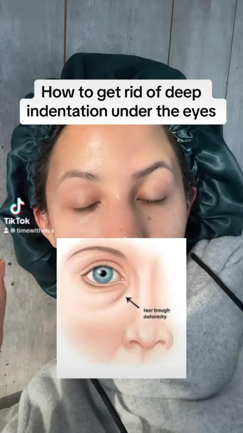 Learn how to naturally lift your face and reduce the indentation under your eyes with these simple, at-home techniques! This video shares easy facial exercises and natural remedies that work to smooth, lift, and rejuvenate tired skin, while also helping to soften under-eye hollows and brighten dark circles. Discover the secrets to a lifted, youthful look without surgery! Perfect for those seeking a natural facelift, non-surgical eye lift, and ways to achieve a refreshed, radiant appearance. #NaturalFaceLift #UnderEyeRemedy #NonSurgicalEyeLift #FaceLiftingExercises #DIYFacial Indentation Under Eye, Reduce Under Eye Darkness, Lift Eyes Naturally, How To Prevent Wrinkles, How To Fix Uneven Eyes, How To Tighten Under Eye Skin, How To Lift Downturned Eyes, Dark Under Eyes Remedy, How To Fix Hollow Eyes