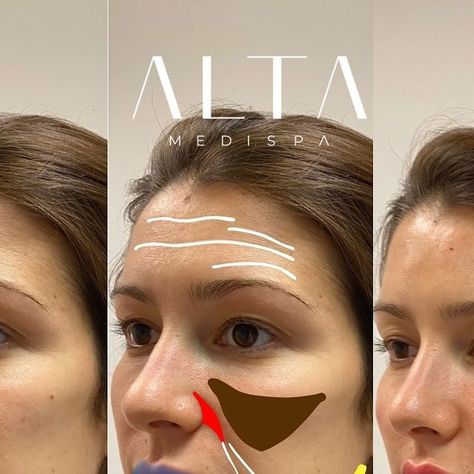 Plastic Surgery • Dermatology on Instagram: "@altamedispa What a full-facial rejuvenation and restoring volume-loss with hyaluronic acid dermal filler looks like 💉 Do you like the results? 👇👇

5mll of dermal filler and skin booster was used for this transformation by @altamedspa based in Beverly Hills and London. Do you like the results 😍⬇️ - Here is what they had to say about this case:

“To restore volume in her cheeks and mid face, she received cheek fillers injections that sculpted a finely tuned cheekbone, and anterior cheeks and pyriform so soften, fill, and smoothen those hollow areas in her mid-face. 

She also received a 2-point Russian nasiolabial filler technique to fill her smile lines and the hollowness. She also had Skin Booster injected to replenish and rejuvenate her sk Skin Booster, Cheek Fillers, Injectables Fillers, Smile Lines, Facial Rejuvenation, Dermal Fillers, Lip Fillers, Dermatology, Her Smile