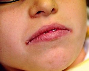 Signs of angular cheilitis will nearly appear at the edges of the mouth. Find out more about cracks corners of mouth diagnosis and its treatments. #angularcheilitisremedyessentialoils Cracked Corners Of Mouth, Angular Cheilitis, Crusty Skin, Natural Aloe Vera, Cracked Lips, Cracked Skin, Skin Disorders, Fungal Infection, My Mouth