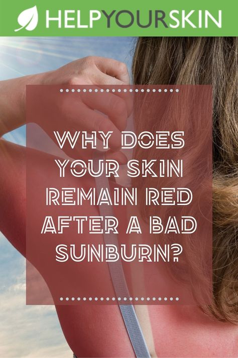 We all know that characteristic feeling of sunburn – the hot, tight feeling of the skin at first, followed by the familiar hot, uncomfortable, burning sensation that can last for days. The effects of a bad sunburn can be visible even after weeks, as the skin takes time to slough off the dead skin cells. You can improve the feel and outcome of a bad sunburn – but even though the burn itself may fade and your skin feel cooler again, why does your skin remain red after a bad sunburn? How To Heal Sunburn Fast, Help Sunburn, Heal Sunburn Overnight, Best For Sunburn, Really Bad Sunburn, Bad Sunburn, Swollen Ankles, Sunburn Relief, Side Effects