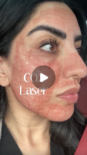 Skinfx Medical Spa on Instagram: "CO2 skin resurfacing is a cosmetic procedure that uses a carbon dioxide (CO2) laser to remove layers of skin in a precise manner. 

This process helps to improve skin tone, texture, and appearance by stimulating collagen production and promoting skin regeneration. It can be used to treat various skin issues such as wrinkles, fine lines, scars, sun damage, and uneven pigmentation. 

However, it typically requires some downtime for the skin to heal properly.

I got mine done at @dmhaesthetics by @dr.o.aesthetics 🖤

Would you try this procedure?👇🏻" Laser Scar Removal Before And After, Skin Regeneration, Skin Resurfacing, Improve Skin Tone, Cosmetic Procedures, Medical Spa, Layers Of Skin, Collagen Production, Carbon Dioxide