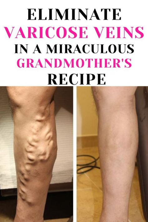 Get rid of varicose veins with a natural recipe that’s easy to make at home. Follow these eight simple steps and enjoy healthier, more beautiful legs. Ingredients: Instructions : Note : The preparation time for this recipe is about 15 minutes. However, you will need to leave the paste on for 30 minutes, so be […] Vericous Veins, Varicose Veins Essential Oils, Varicose Vein Remedy, Leg Veins, Vein Removal, Natural Health Remedies, Natural Beauty Tips, Home Remedies, Cider