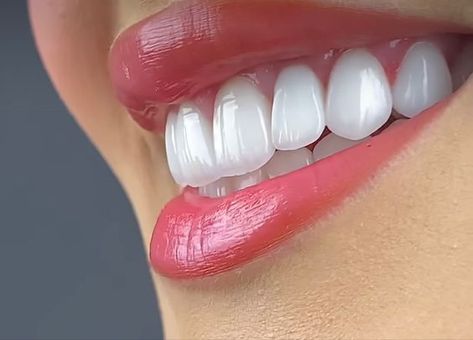 Hollywood Smile Veneers, Cosmetic Dentistry Veneers, Dental Wallpaper, Cosmetic Web, Teeth Aesthetic, Dental Smile, Logo Dental, Dental Advertising, Cosmetic Dentistry Procedures