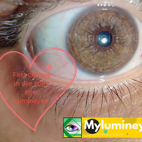 First changes start in eye color after Lumineyes laser eye color change without surgery procedure. #changeineyecolor #lumineyes #lasereyecolorchange #changeyecolor #lighteningiris https://mylumineyes.com/why-does-my-eye-change-color/ Eye Color Change Surgery, Laser Eye, Eye Color, Surgery, Color Change, Color