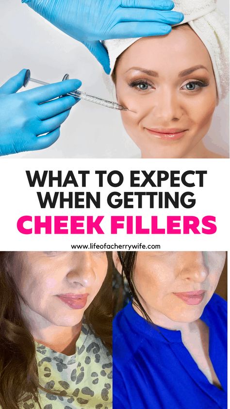 Natural Cheek Filler, Check Filler Before And After, Before And After Cheek Filler, Midface Cheek Filler, Face Fillers Before And After Cheeks, Cheek Filler Before And After, Facial Fillers Before And After, Face Fillers Before And After, Face Balancing Fillers