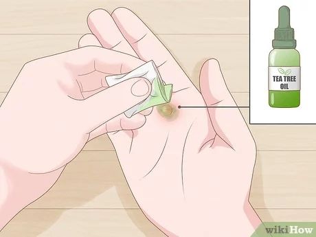 4 Ways to Heal Blisters - wikiHow Heal Blisters, Blister Remedies, How To Heal Blisters, Ways To Heal, Green Tea Bags, Prevent Blisters, Family Medicine, School Of Medicine, Aloe Vera Gel