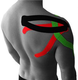 ARES Kinesiology Tape: Frozen Shoulder Frozen Shoulder Exercises, Crossfit Baby, Shoulder Anatomy, Shoulder Rehab, Kinesio Tape, Kt Tape, Kinesio Taping, Frozen Shoulder, Sports Tape