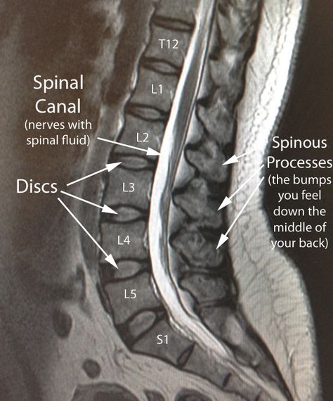 L5 S1, Medical Radiography, Mri Technologist, Disc Herniation, Medical Items, Mri Brain, Radiology Student, Basic Anatomy And Physiology, Lumbar Spine