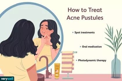 Pustules Acne, How To Treat Acne, Dermatology, Something Else, Spot On, Medical, Acne