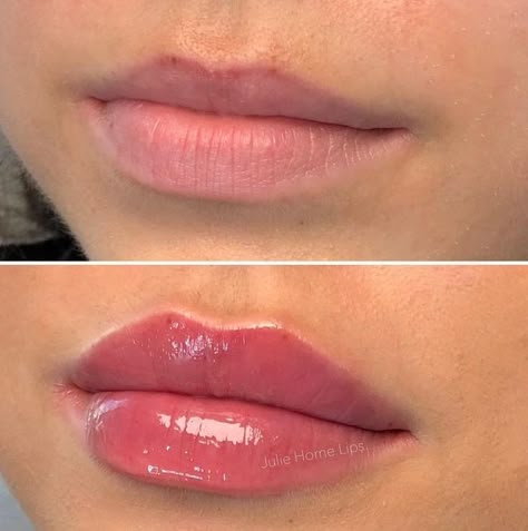 Natural Russian Lips, Lip Fillers Natural Look, Lip Filler Inspiration 0.5ml, Restalyne Kysse Lips, Lip Filler Inspiration Natural, Lip Filler Inspiration 1ml, Hyaluronic Lips, 0.5 Lip Filler, Lip Filler Before And After 1ml