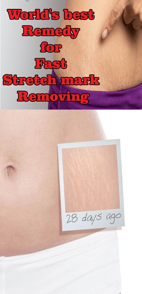 Strech Marks Remedies, Strech Marks, Stretch Mark Remedies, Lotion For Oily Skin, Stretch Mark Cream, Stretch Mark Removal, Stretch Mark, Moisturizer For Oily Skin, Baking Soda Shampoo