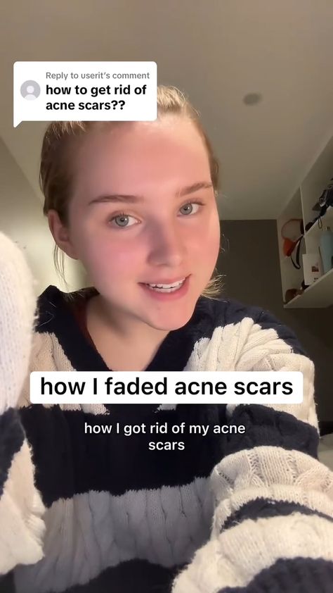 How i faded acne scars Acne Scar Tips, Acne Scar Skin Care Products, What Helps With Acne Scarring, How To Get Rid Of Scarring From Acne, Acne Scar Removal Skincare, Deep Acne Scar Removal, How To Reduce Acne Scarring, How To Help Acne Scarring, Acne Scarring Products