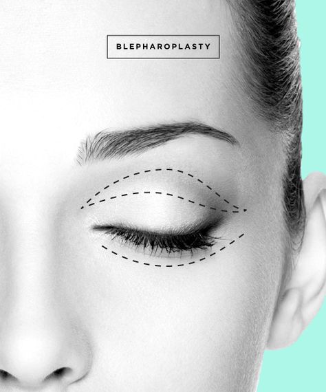 Eyelid Surgery aka Blepharoplasty Rhinoplasty Recovery, Bad Plastic Surgeries, Facial Aging, Facial Procedure, Facial Surgery, Eyelid Lift, Plastic Surgery Procedures, Facial Plastic Surgery, Excess Skin