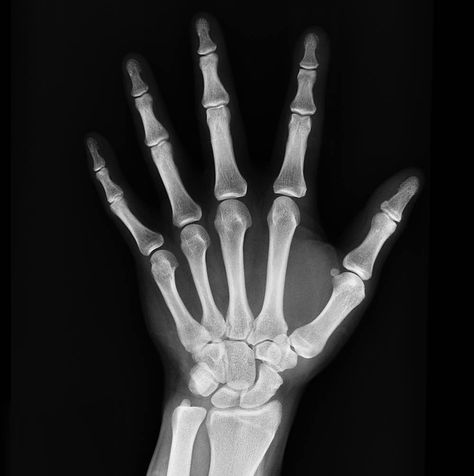 So, your blood work has come in and you are not getting enough calcium. This can be dangerous the older you get, as brittle bones can easily break and take a long time to heal. Here are some practical steps you can take to make sure your bones stay h... Xray Art, Sepia Art, Bone Loss, Bone Density, Human Hand, Hand Tattoo, Radiology, Bone Health, X Ray