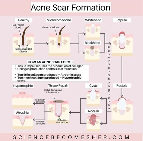 Acne Meaning, Pimple Causes, Hypertrophic Scars, Skin Facts, Face Skincare, Skin Aesthetics, Facial Aesthetics, Acne Scar, Good Skin Tips